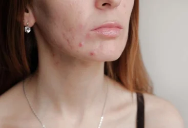 Acné hormonale, comment la reconnaître?