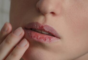 Lèvres gercées : comment les soigner?