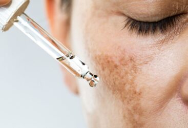 Hyperpigmentation : comment la prévenir et la traiter