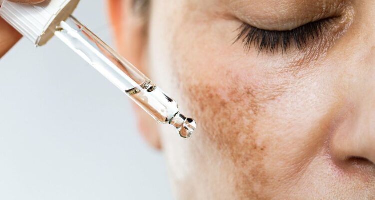 Hyperpigmentation : comment la prévenir et la traiter