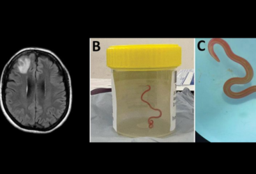 AUSTRALIE : UN VER VIVANT TROUVÉ DANS LE CERVEAU D&rsquo;UNE FEMME.  