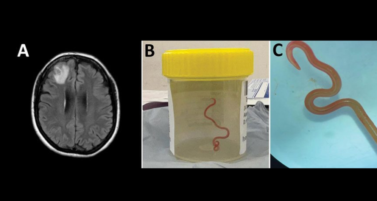AUSTRALIE : UN VER VIVANT TROUVÉ DANS LE CERVEAU D&rsquo;UNE FEMME.  