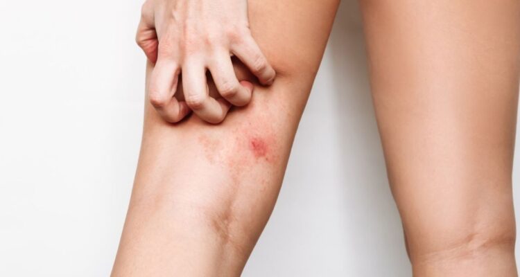 Comment les Couleurs Vestimentaires Peuvent Attirer les Moustiques : Les Découvertes d&rsquo;une Étude Récente.