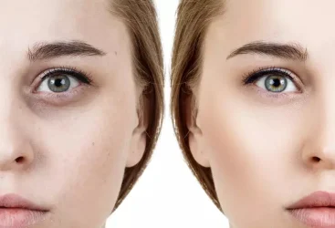 Prenez soin de vos cernes : Conseils d&rsquo;un dermatologue pour une peau éclatante.