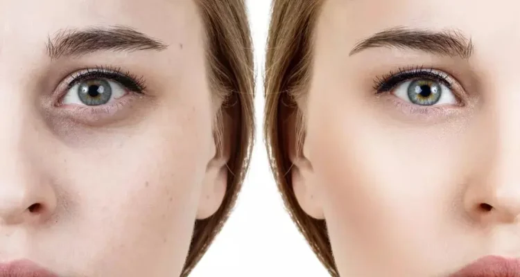 Prenez soin de vos cernes : Conseils d&rsquo;un dermatologue pour une peau éclatante.