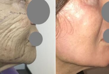 Peeling au Phénol : Tout sur cette Procédure de Rajeunissement Cutané.