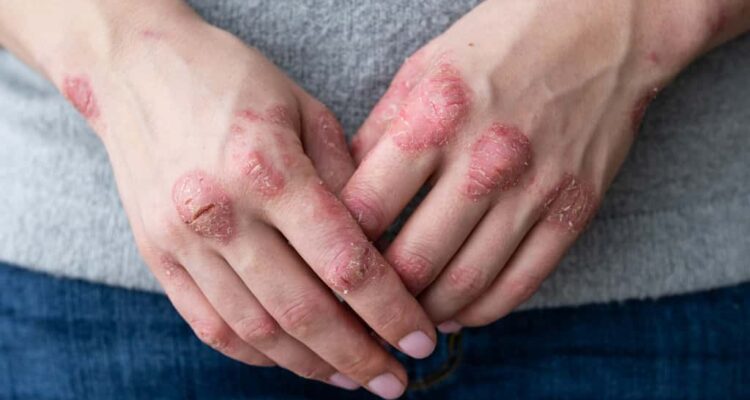 Comprendre la Prévalence des Maladies Auto-Immunes chez les Femmes.