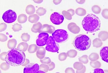 France: Une Nouvelle Avancée dans le Traitement de la Leucémie Myéloïde Aiguë.