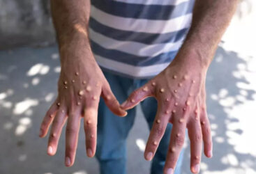 Mesures Préventives en Tunisie pour Empêcher l&rsquo;Introduction de la Variole du Singe.