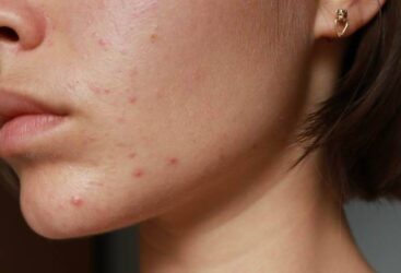 Acné liée au stress : comprendre et limiter les dommages.